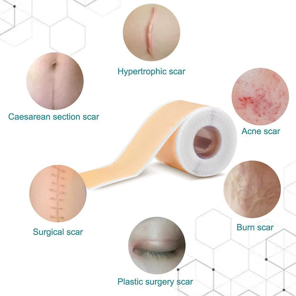 150Cm Silicone Gel Scar Sheet Patch Treatment Removal Tape Acne Trauma Burn Scar Cover Skin Repair Section Ear Beauty
